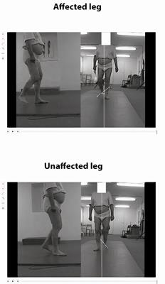 Assessment of Agreement Between a New Application to Compute the Wisconsin Gait Score and 3-Dimensional Gait Analysis, and Reliability of the Application in Stroke Patients